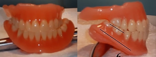 Kuvassa yläkokoproteesi, jossa vain kymmenen hammasta