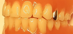 Kultakuorikko hammasproteesissa