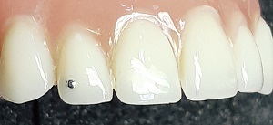 1mm. Teppdent-hammaskoru