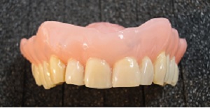 Yläkokoproteesissa on kolmen sävyisiä hampaita